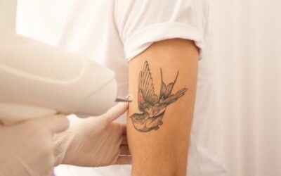 ¿Cómo es el proceso de eliminación de tatuajes?